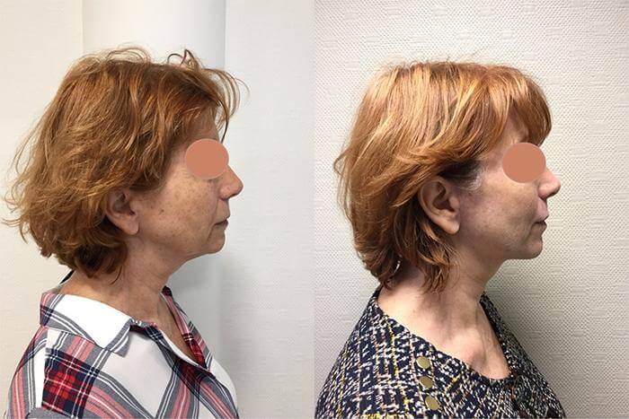 Photos avant aprés du visage d'une femme senior ayant eu recours à un lifting du visage