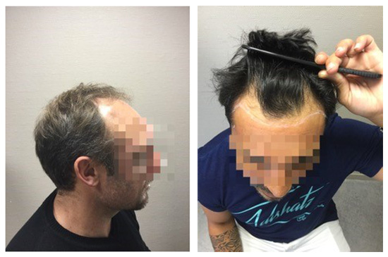 Photos après une opération de micro greffe des cheveux par le Docteur Lavocat à Bordeaux
