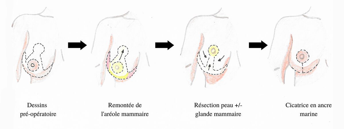 Schema explicatif de la forme des cicatrices lors d'une réduction mammaire