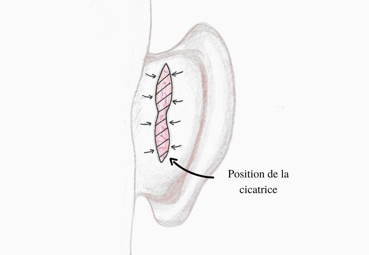 Schema illustrant la zone d'incision et de cicatrice lors d'une otoplastie