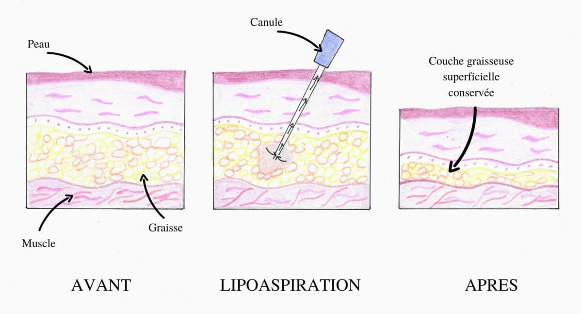 Schema illustrant le procédé d'aspiration de graisse par liposuccion