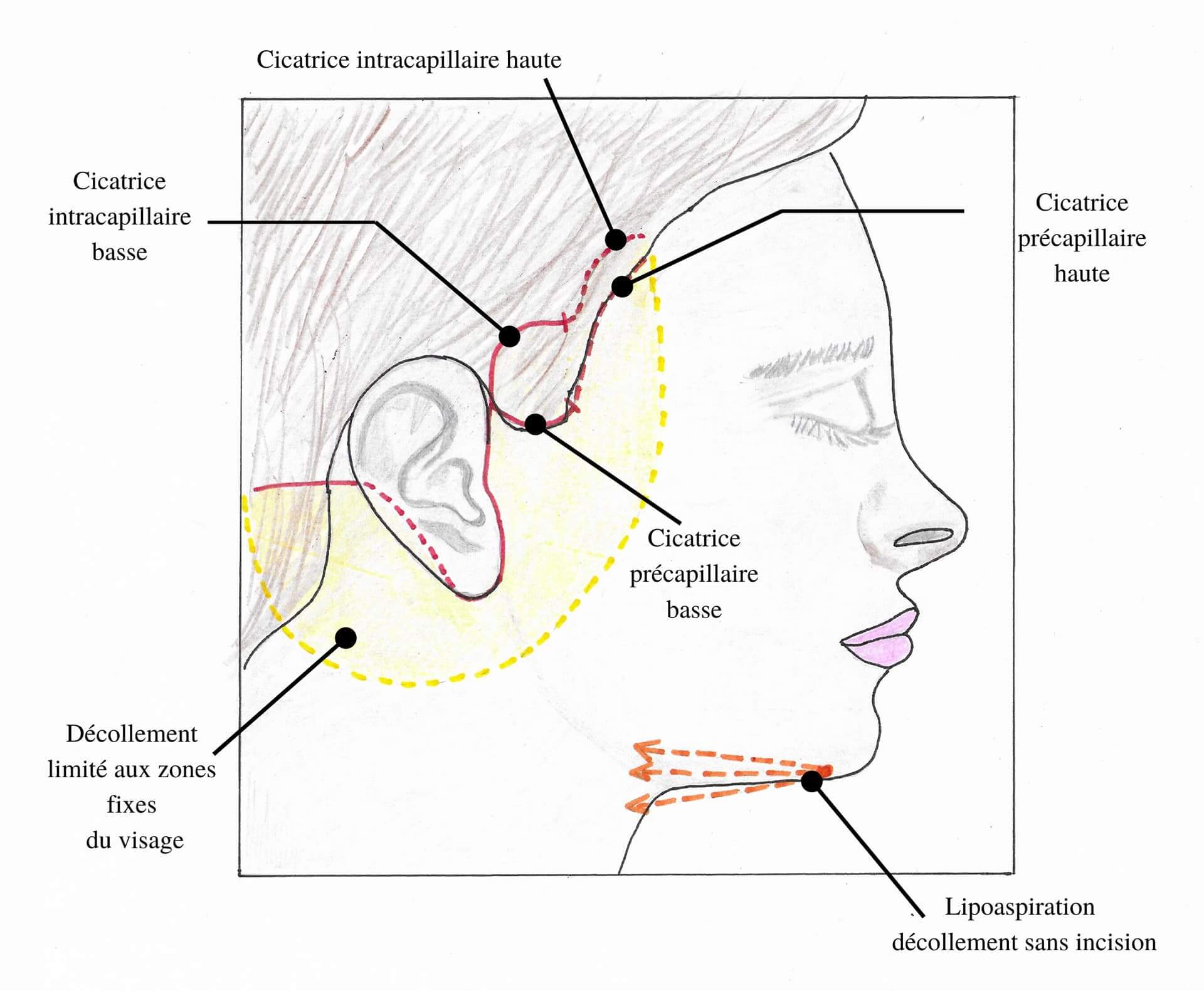 Schema explicant les différentes étapes d'un lifting du visage