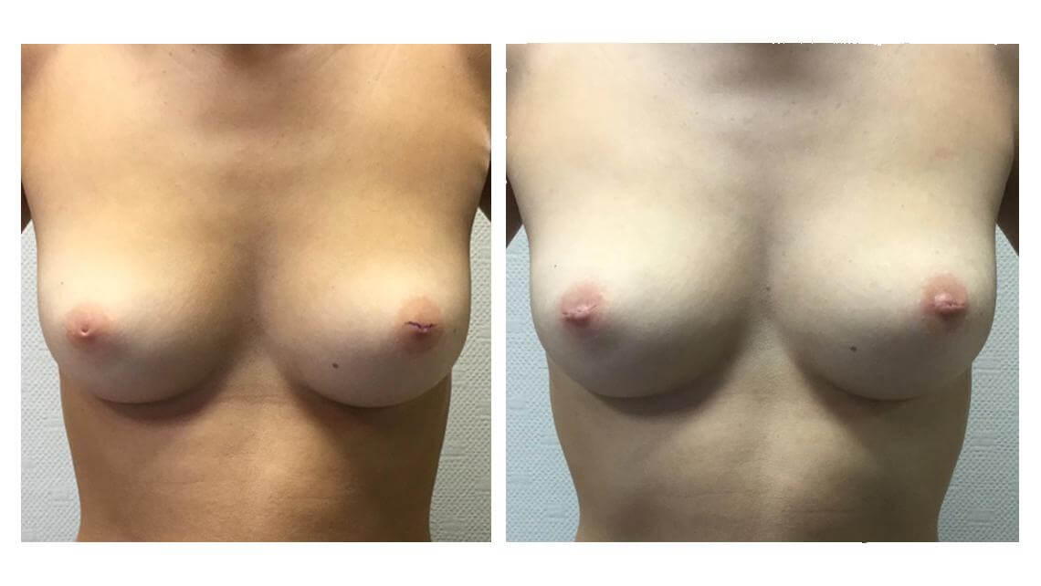 Photos avant après d'une chirurgie esthétique de mamelons invaginés
