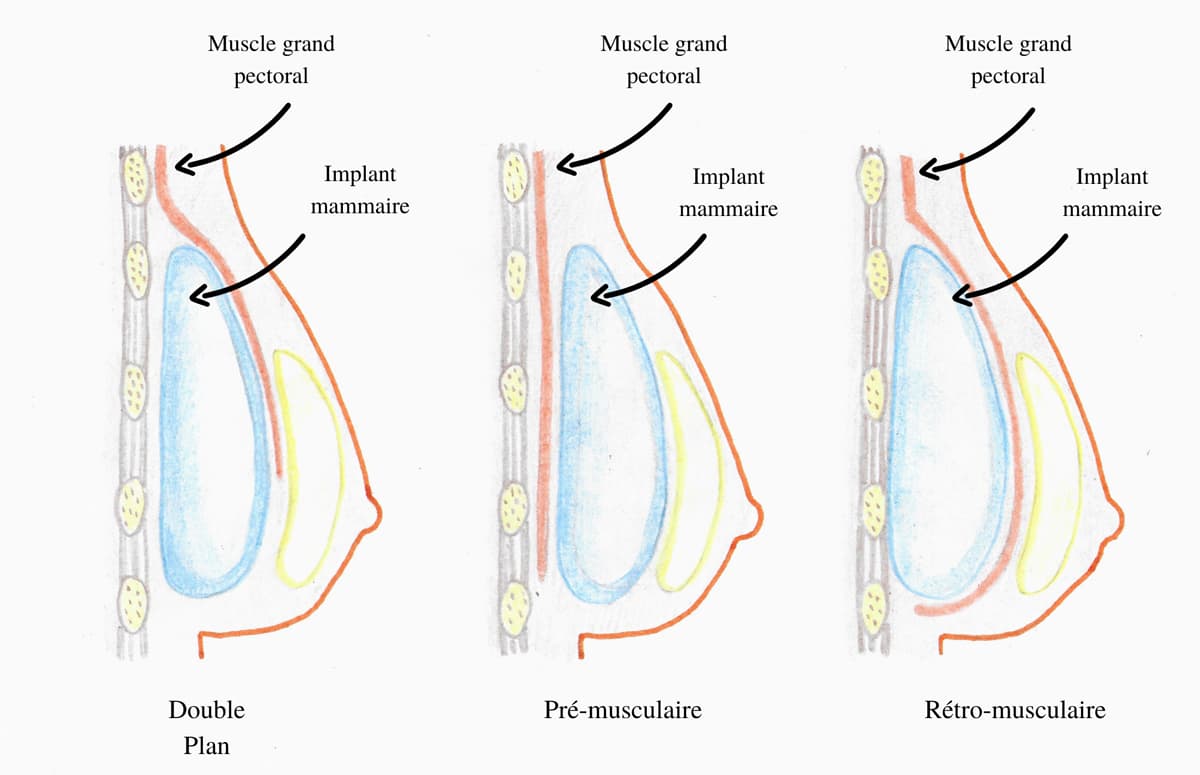 Schema expliquant les différentes positions possibles d'un implant mammaire
