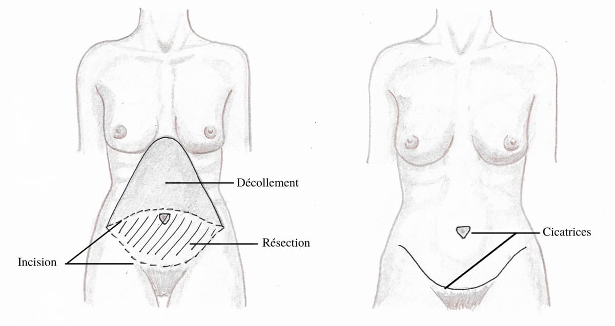 Schema explicatif des gestes d'une abdominoplastie
