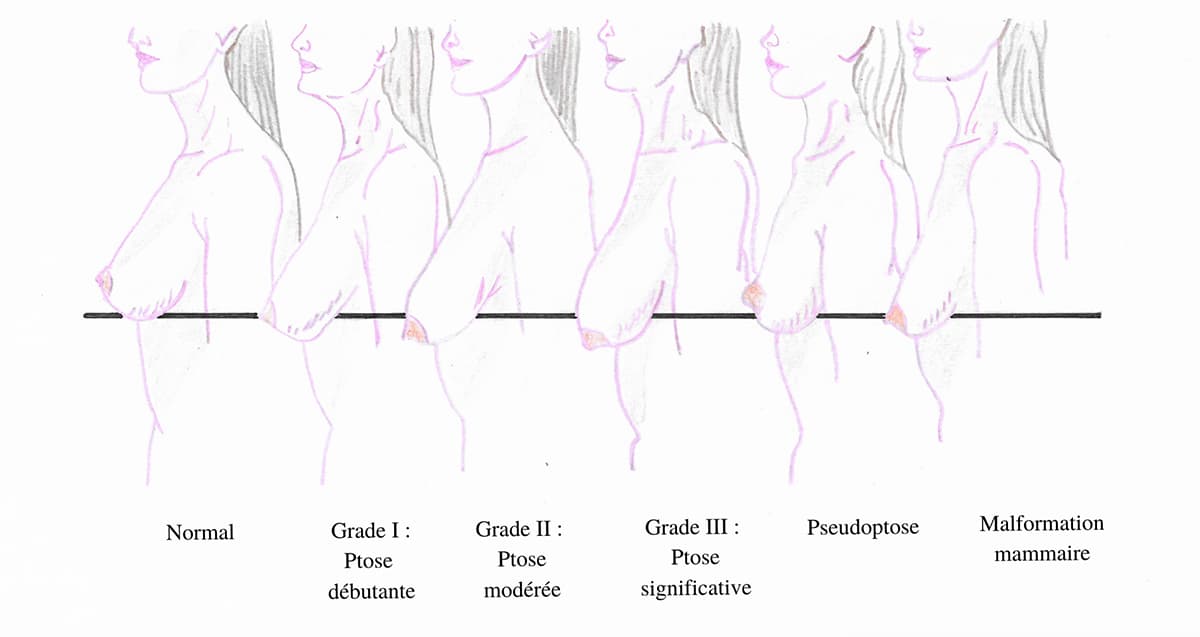 Schema illustrant les différents stades de ptose mammaire