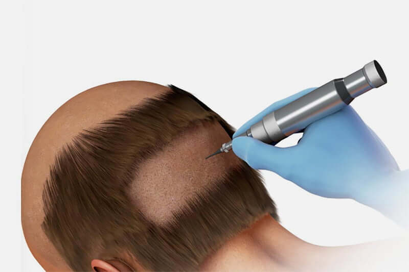Technique de greffe de cheveux FUE