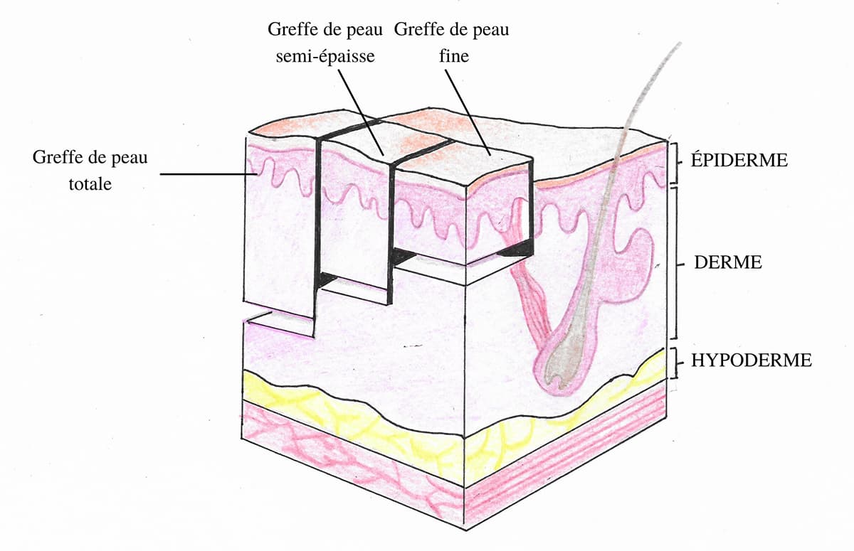 Les differentes types de peau lors d'une greffe de peau