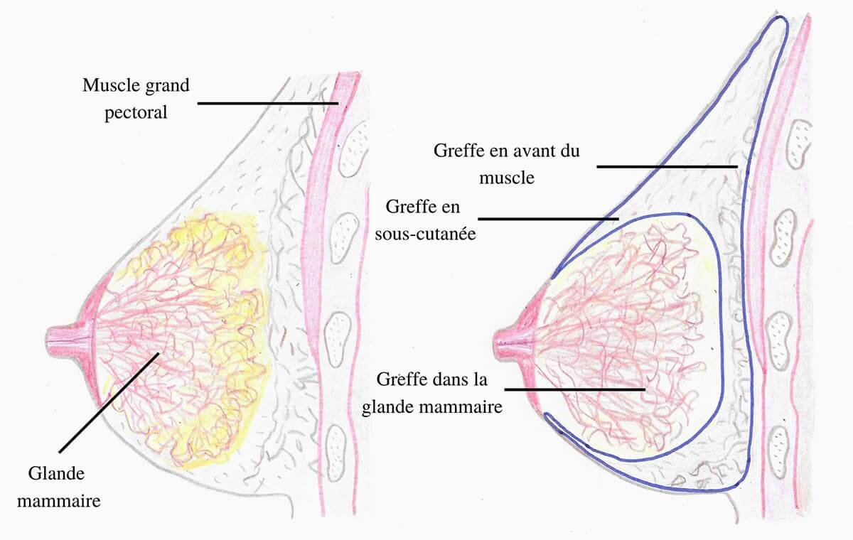 Schema des zones d'injection de la graisse lors d'un lipofilling mammaire