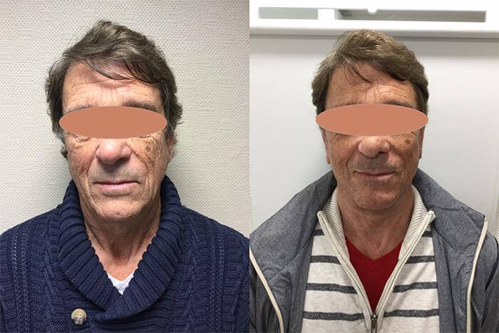 Photos avant aprés du visage d'une femme senior ayant eu recours à un lifting du visage