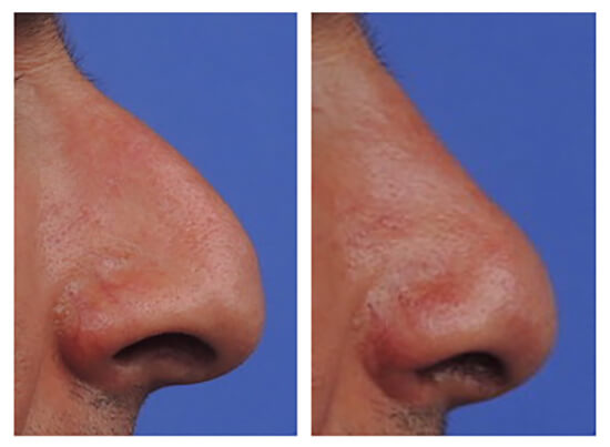 Chirurgie du nez : bossectomie avant apres opération