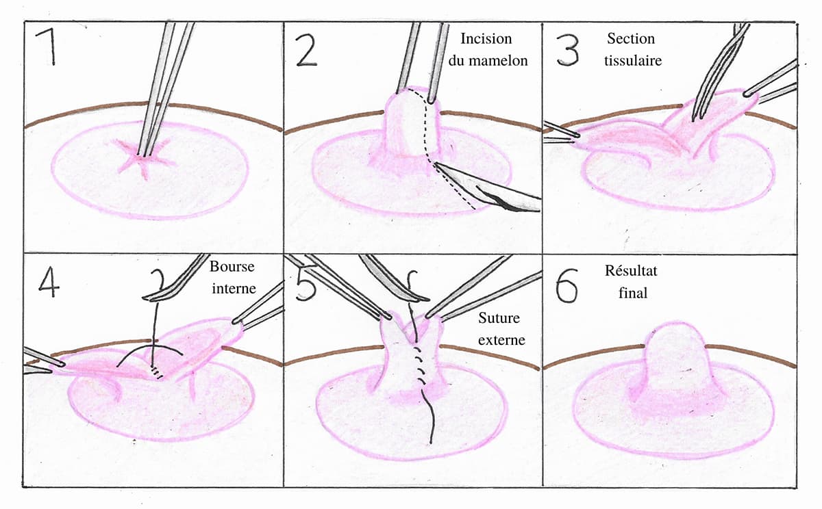 Schema illustrant les différentes étapes de la chirurgie des mamelons invaginés