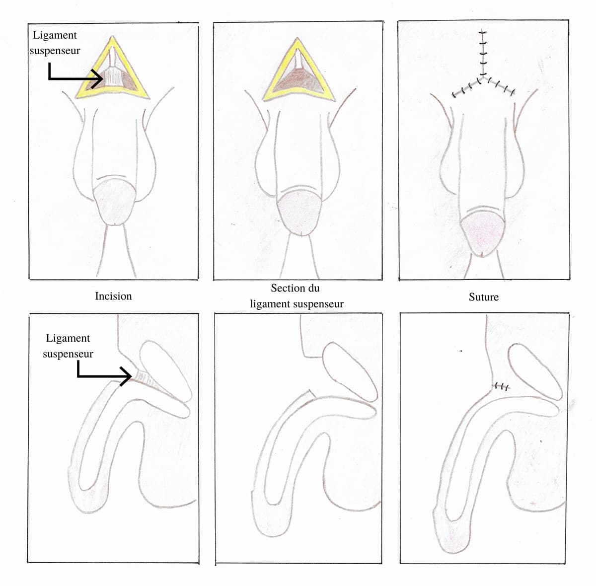 Schema illustrant le principe chirurgical d'une pénoplastie