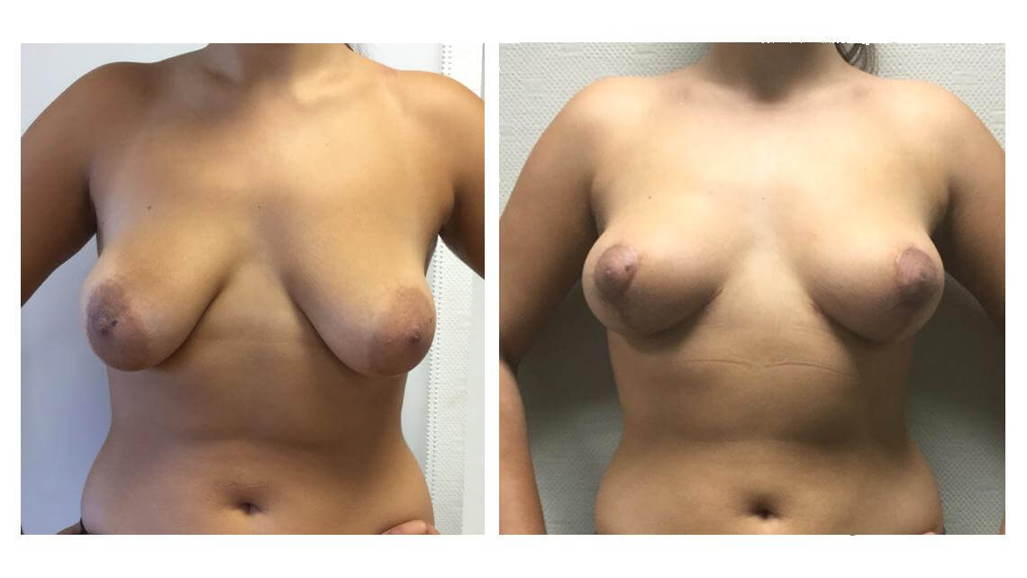 Photos avant aprés d'une chirurgie des seins tubereux