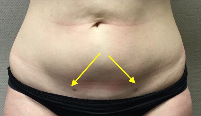 Cicatrices visibles sur une patiente ayant eu recours à une lipoaspiration du ventre