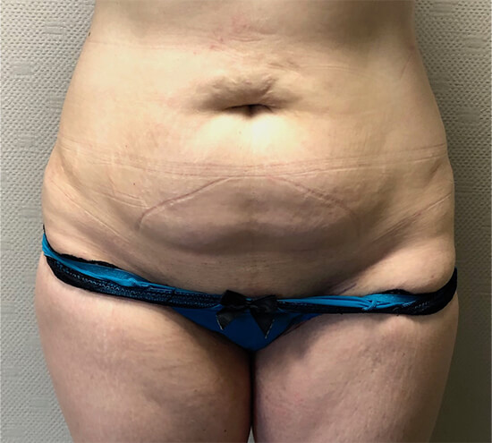 Femme présentant un excès de graisse au niveau du ventre