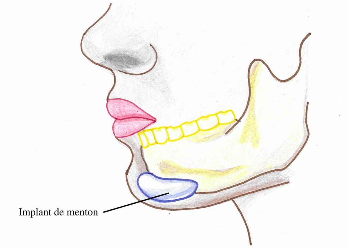 Schema illustrant la pose d'implant dans le menton