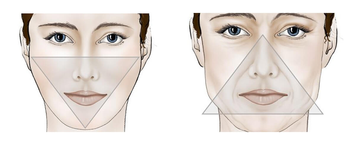 Schema présentant l'affaissement du visage dû à l'âge