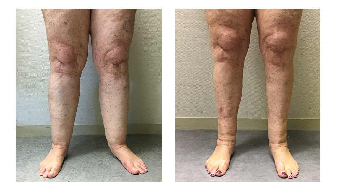 Lipoaspiration des jambes | Chirurgie esthétique à Bordeaux