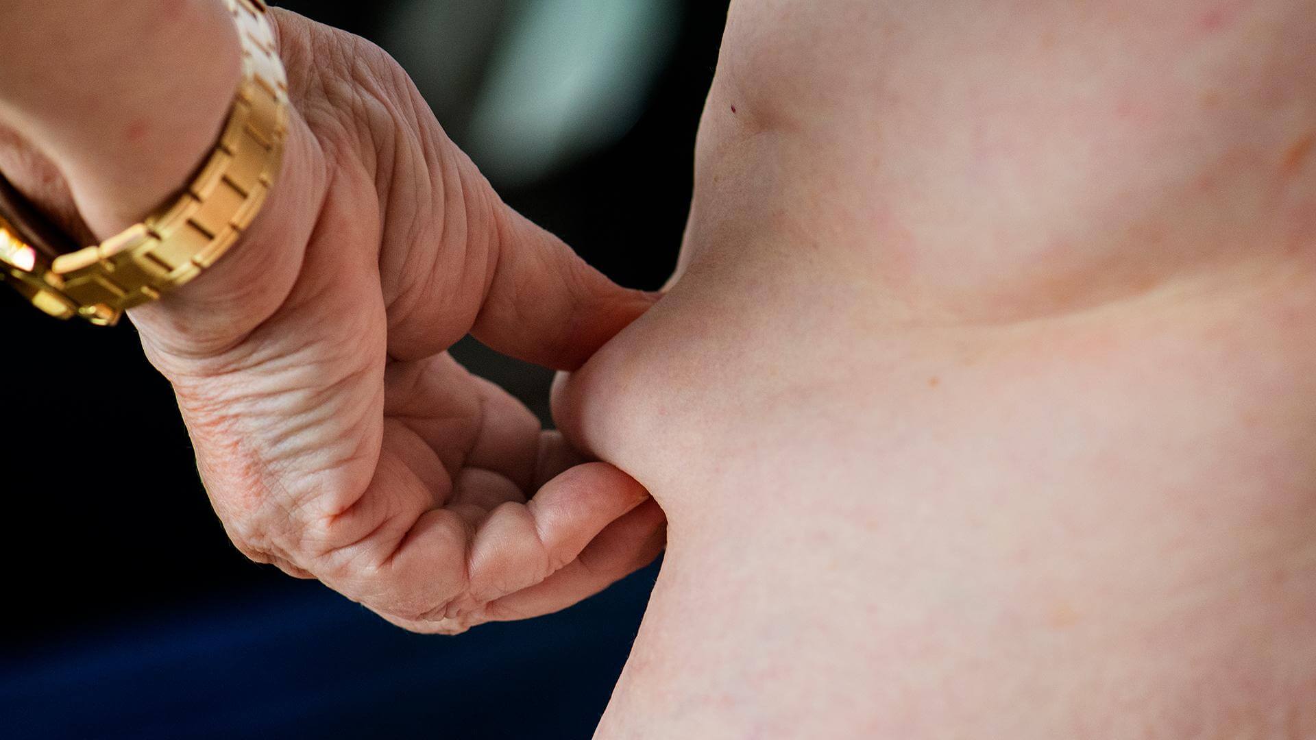 Femme de dos pinçant sa peau pour vérifier les résultats d'une liposuccion