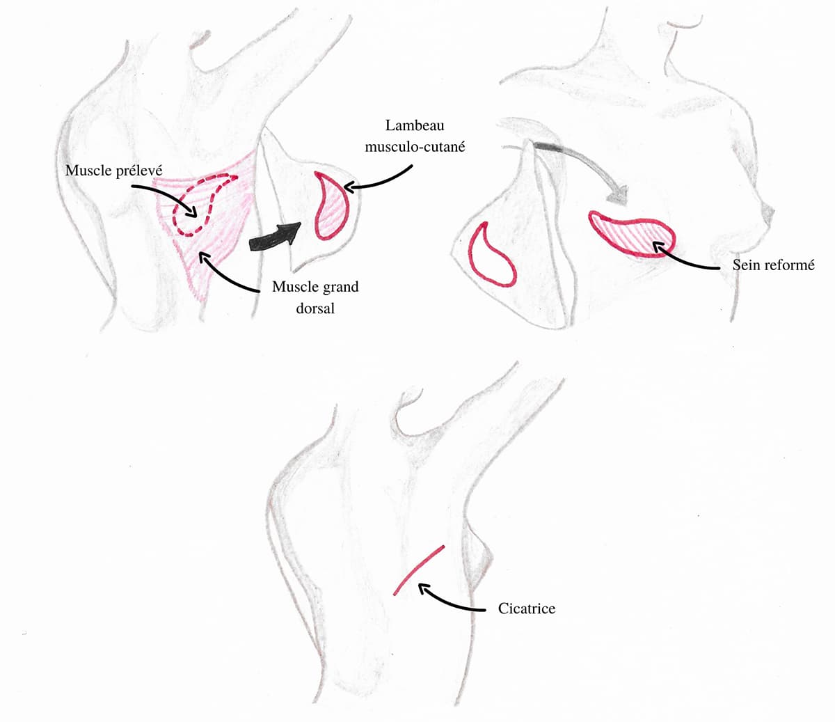 Schema exolicatif de la technique de reconstruction mammaire par lambeau du grand dorsal