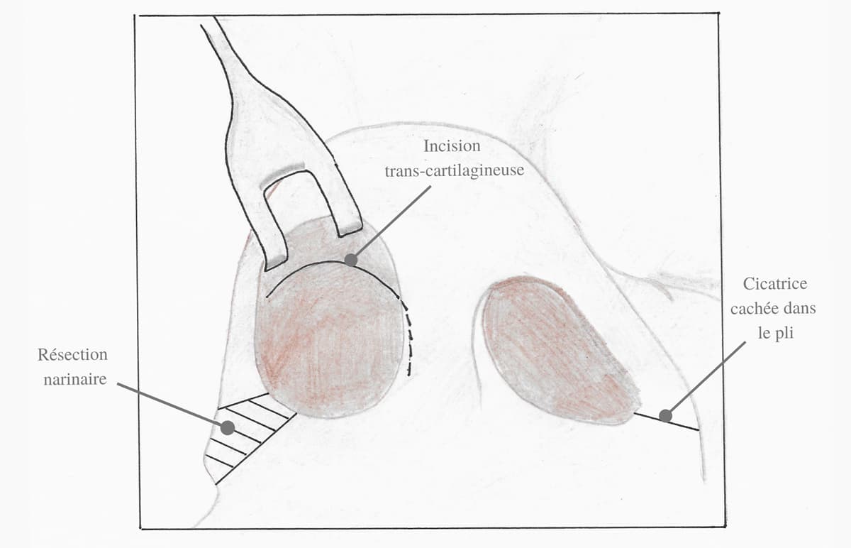 Schema explicatif des gestes d'une rhinoplastie au niveau des narines