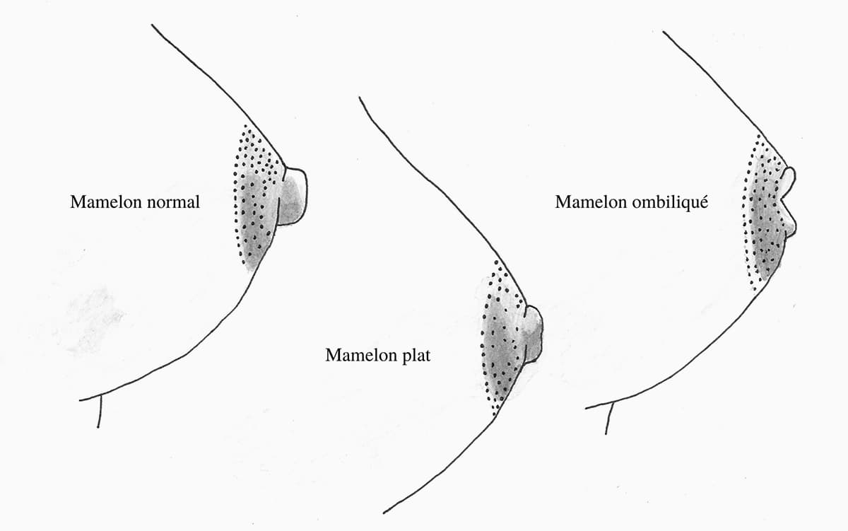 Schema illustrant l'aspect des différents types de mamelons de sein