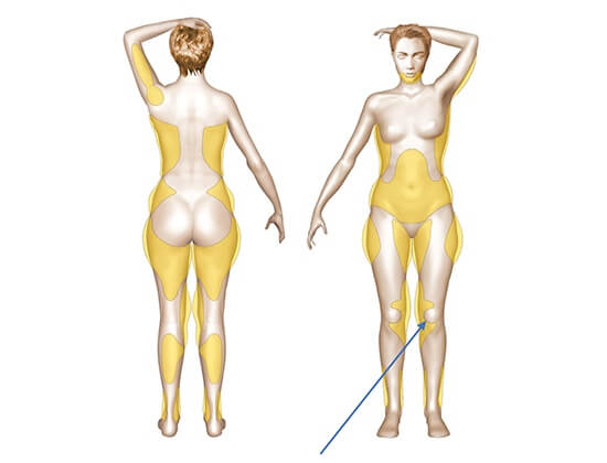 Schema présentant la zone du genou traitable par lipoaspiration