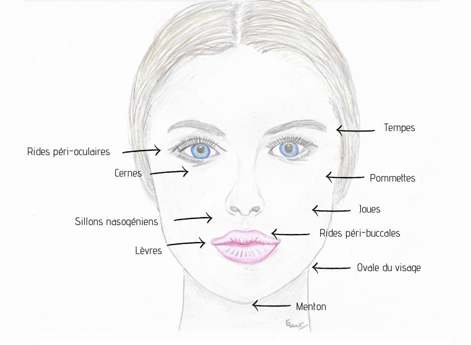 Schema illustrant les partie du visage pouvant être traitées par acide hyaluronique